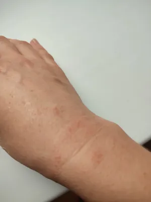 Картинка сыпи на запястьях рук: как определить вид заболевания