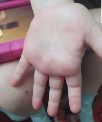 Сыпь у ребенка на руках фотографии