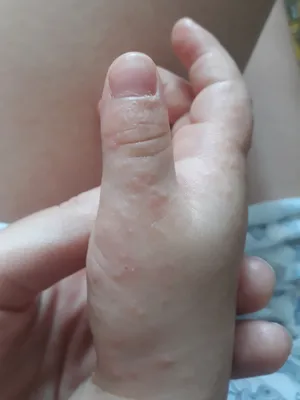Фотография рук малыша с сыпью