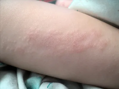 Фото сыпи на коже рук ребенка