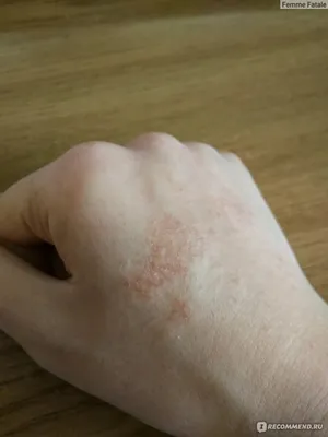 Сыпь на руках: фото контактного дерматита