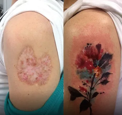 15 удивительных тату, благодаря которым шрамы и некрасивые родинки стали  украшением на телах людей