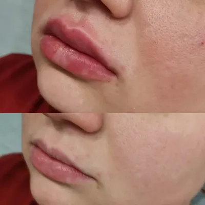 Перед и после: фотографии татуажа губ 