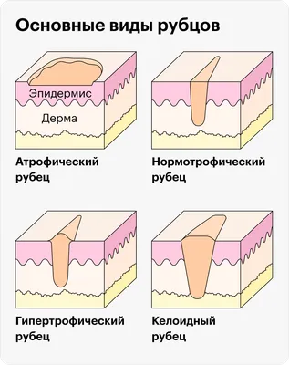 Шрамы, но не проблема: Татуаж шрамов