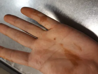Фото темных пятен на коже рук для сравнения различных типов пигментации