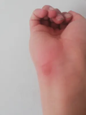 Фотографии темных пятен на коже рук для лечения