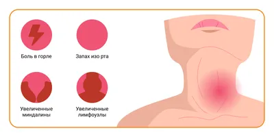 Когда нужно удалять гланды? Выбор тактики лечения при хроническом тонзиллите