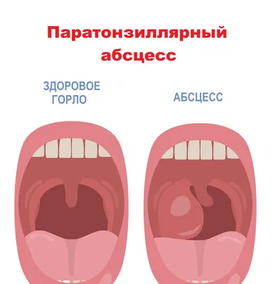 Хронический тонзиллит лечение симптомы, как лечить хронический тонзиллит -  блог Furasol®