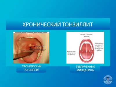 Тонзиллит - причины появления, симптомы заболевания, диагностика и способы  лечения