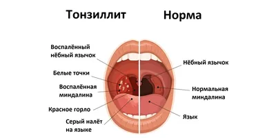 Симптомы тонзиллита / Статьи / Семейная клиника А-Медия