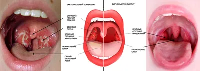 Тонзиллит у ребенка: что делать? Профилактика и лечение тонзиллита у детей