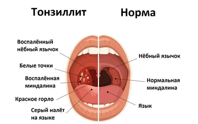 Хронический Тонзиллит Микроскопическое Изображение Тонзиллярной Ткани  Показывают Лимфоидные Фолликулы Стратифицированного Плоского Э — стоковые  фотографии и другие картинки Аденокарцинома - iStock