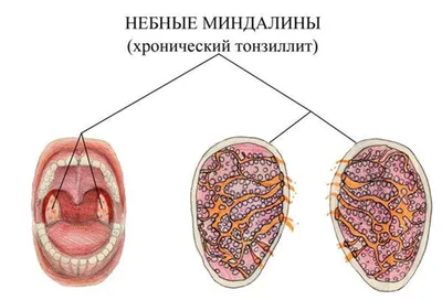 Тонзиллит и его лечение | Врачебная Династия | Дзен