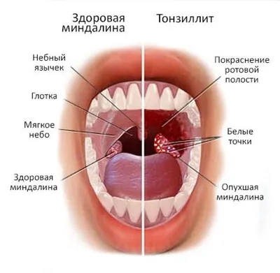 Тонзиллит лечение у детей и взрослых в ЛОР Клинике Оренбург