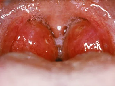 Blog | Что такое воспаление миндалин (тонзиллит)? Каковы симптомы?