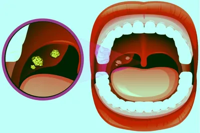 Хронический тонзиллит - признаки, причины, симптомы, лечение и профилактика  - iDoctor.kz