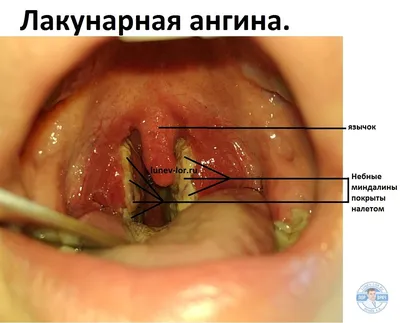 Тонзиллит консультация лечение в клинике Санкт-Петербург ID-CLINIC