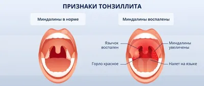 Антисептическое средство растительного происхождения Bionorica Тонзилгон Н  - «Вылечила острый тонзиллит за один день.+++фото» | отзывы