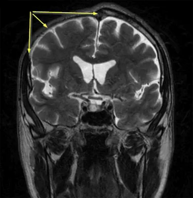 Фото трепанации черепа с использованием компьютерной томографии