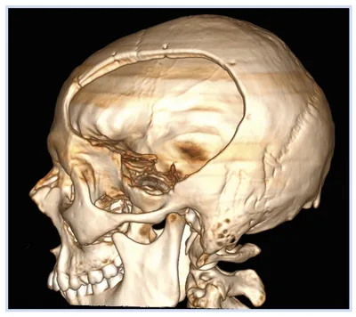 Изображения рисков и осложнений при трепанации черепа