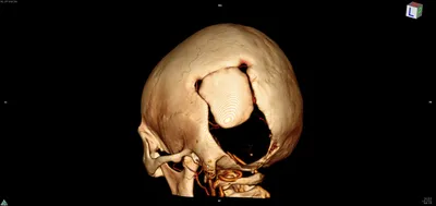 Картинки операции трепанации черепа: боковой профиль