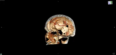 Ужасающие фотографии трепанации черепа