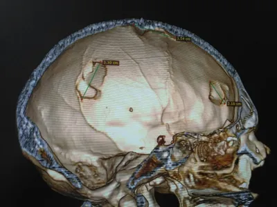 Изображения черепов с трепанацией для обучения студентов медицины