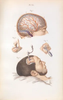 Фотографии черепов с трепанацией для медицинских музеев
