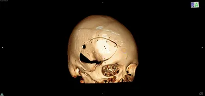 Изображения процесса трепанации черепа