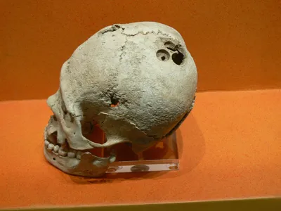 Изображения черепов с открытой трепанационной раной