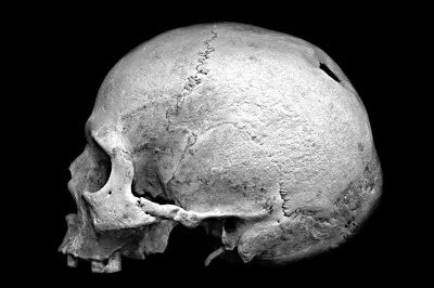 Фотографии черепов с различными размерами отверстий после трепанации
