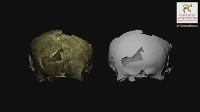 Фото черепов с использованием различных методов трепанации