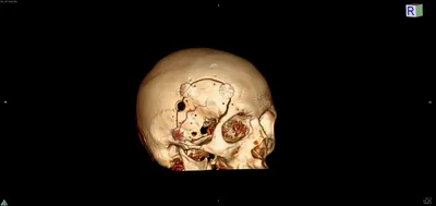 Уникальные картинки трепанации черепа