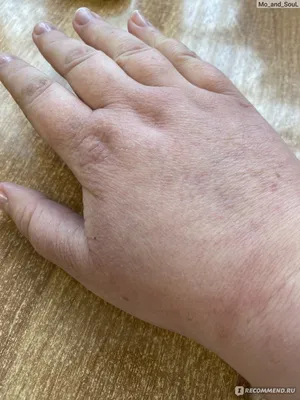 Изображение трещины на руке перед лечением