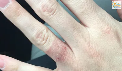 Фотографии трещин на пальцах рук: возможные осложнения