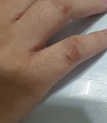 Изображения трещин на пальцах рук: как предотвратить повреждения