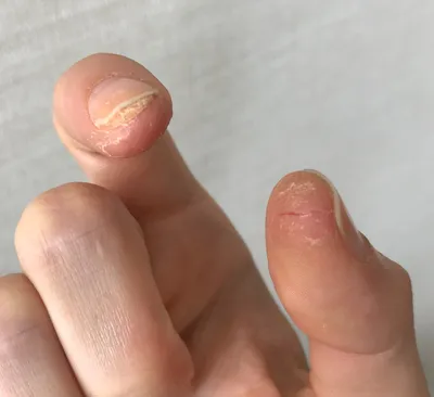 Фото трещин на пальцах рук: как укрепить ногти