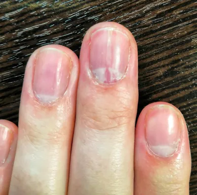Фотки трещин на пальцах рук: как правильно ухаживать за кожей
