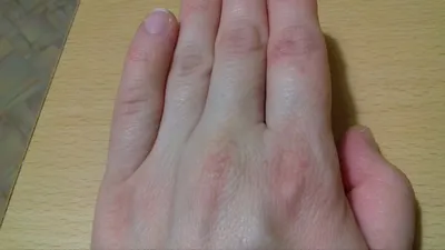 Трещины на пальцах рук: фото в большом разрешении