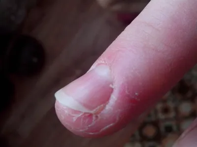 Фото трещин на пальцах рук: как избавиться от проблемы