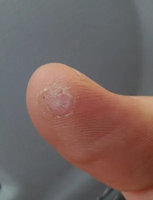 Трещины на пальцах рук: фото современных методов лечения