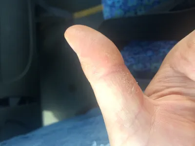 Трещины на пальцах рук: фото с эффектом размытия