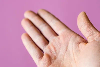 Изображение трещин на пальцах рук: натуральное освещение