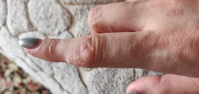 Изображение трещин на пальцах рук: сильный контраст