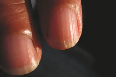 Картинка трещин на пальцах рук: белый фон