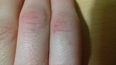 Фото трещин на пальцах рук: причины и симптомы