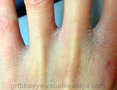 Фотография рук с трескающейся кожей