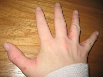 Изображение рук с проблемной кожей