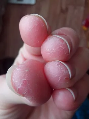 Фото трескающихся рук - как улучшить состояние кожи в домашних условиях