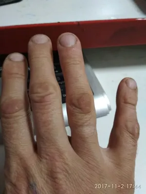 Изображения рук с трескающейся кожей - как избежать дискомфорта и боли